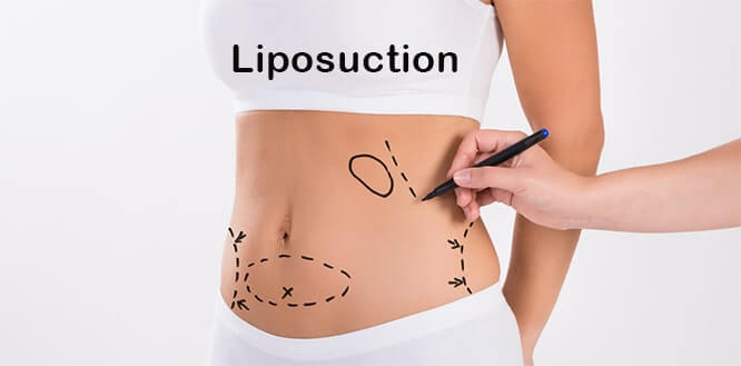 liposuction yağ aldırma fiyatları