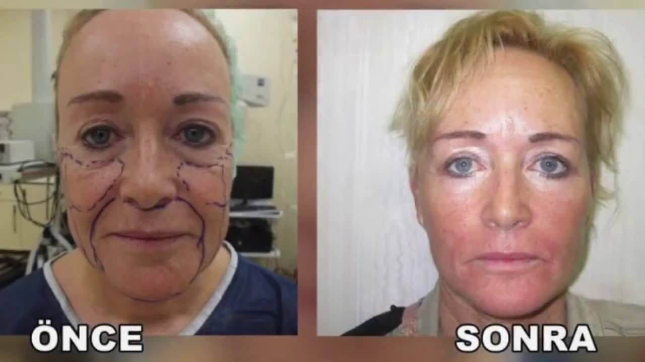 yüz germe ameliyatı öncesi ve sonrası