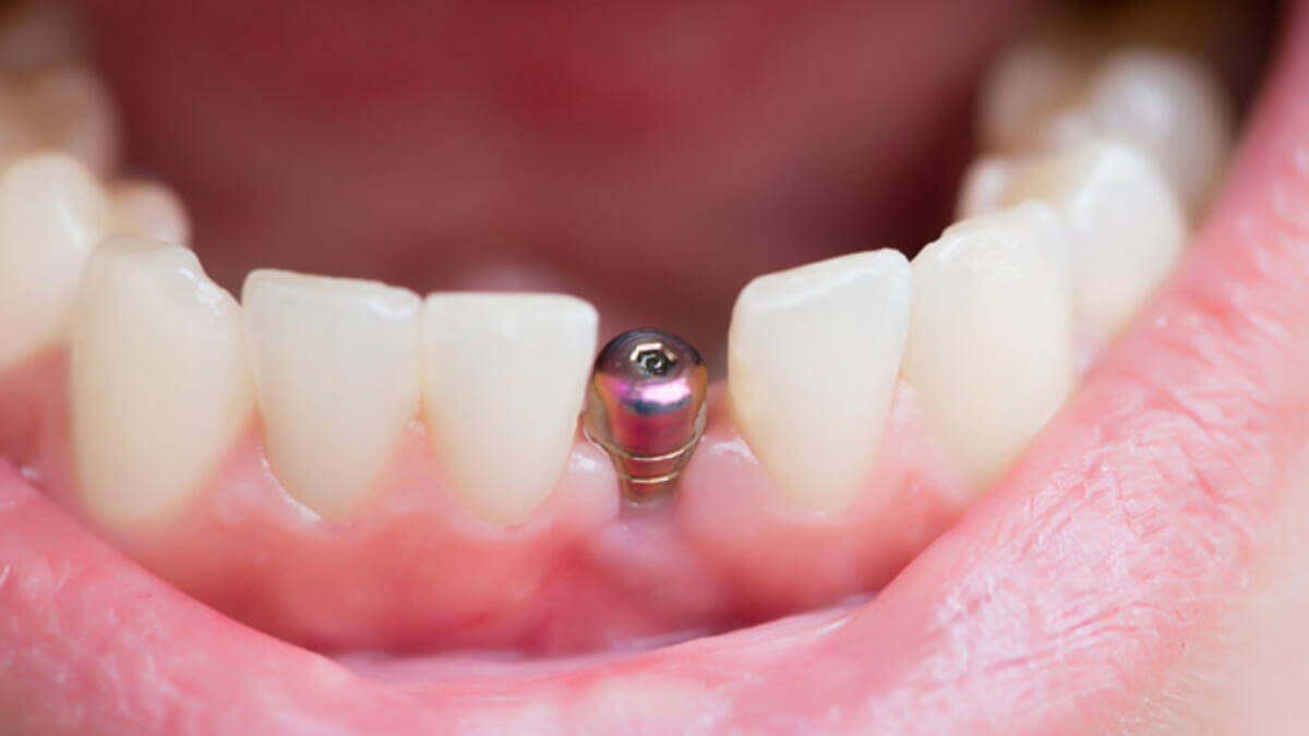 diş implanti fiyatları