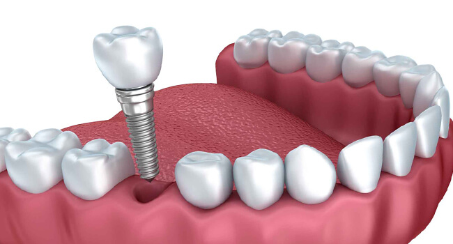 diş implanti nedir