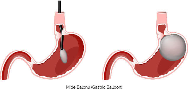 mide balonu ameliyatı nasıl yapılır