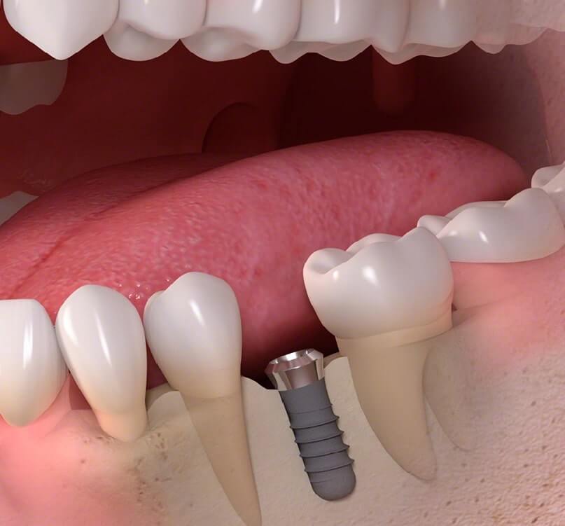 diş implanti yapılışı